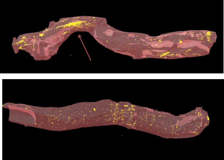 Atherosclerosis